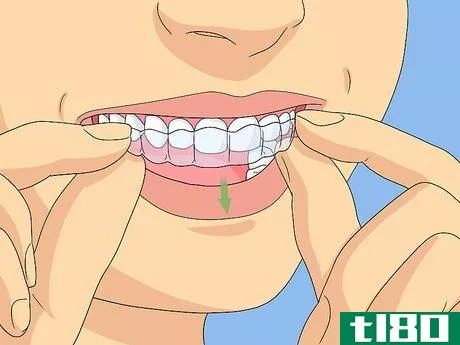 Image titled Clean Invisalign Step 1