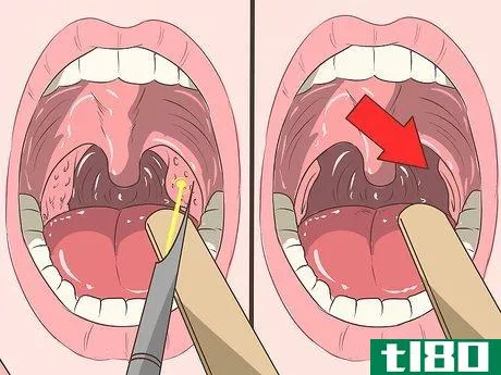 Image titled Remove Tonsil Stones (Tonsilloliths) Step 17