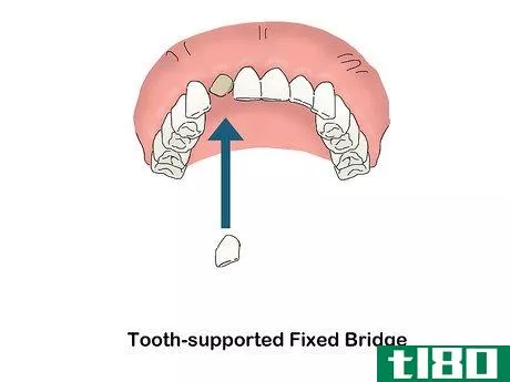Image titled Buy Dentures Step 4