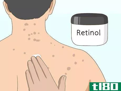 Image titled Get Rid of Back Acne Scars Step 3
