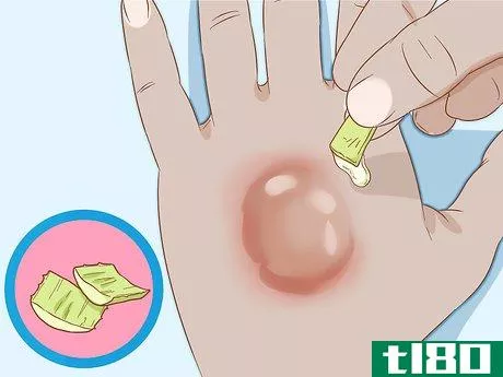 Image titled Get Rid of Poison Ivy Rashes Step 13
