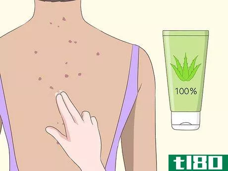 Image titled Get Rid of Back Acne Scars Step 9