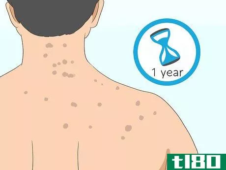 Image titled Get Rid of Back Acne Scars Step 1
