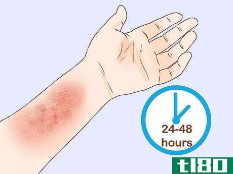 Image titled Get Rid of Poison Ivy Rashes Step 1