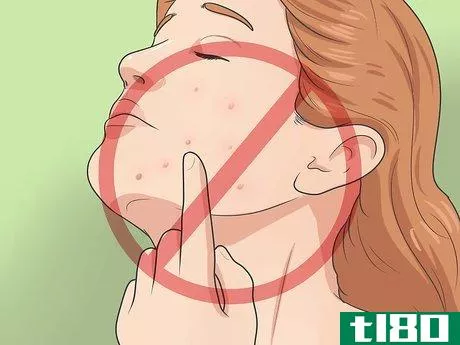 Image titled Heal Acne Fast and Naturally Step 3