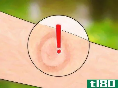 Image titled Get Bug Bites to Stop Itching Step 19