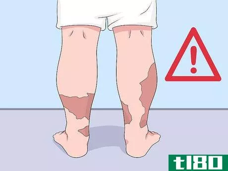 Image titled Prevent Bruising Step 12