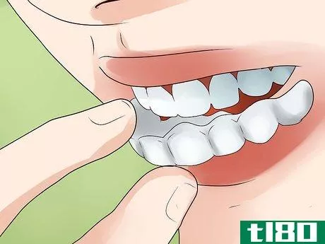 Image titled Clean Invisalign Step 1