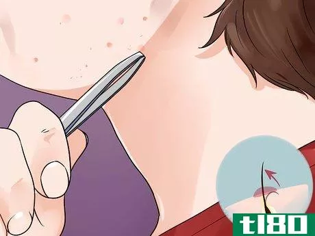 Image titled Remove Ingrown Hair on Your Face Step 2
