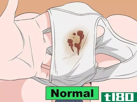 Image titled Tell if Vaginal Discharge Is Normal Step 5