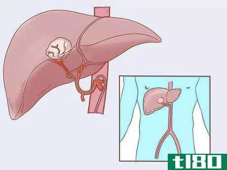 Image titled Treat Liver Cancer Step 12
