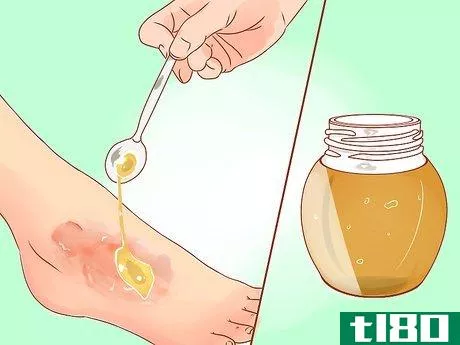 Image titled Treat a Burn Using Honey Step 5