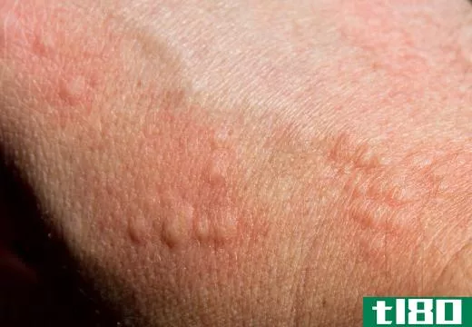 Sandfly bites can cause a reaction such as hives.