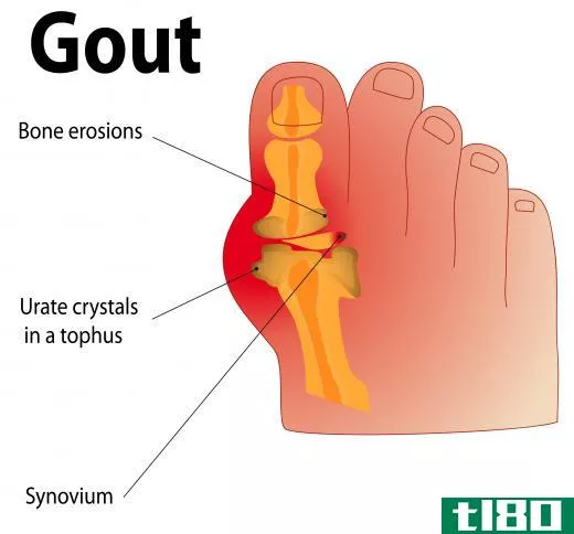 Nettle has been used for centuries as a herbal treatment for gout.