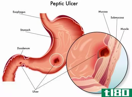 Boswellia may be helpful in treating ulcers.