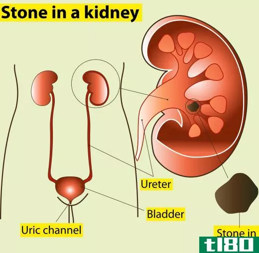 One ailment that elettaria has been used to treat is kidney stones.