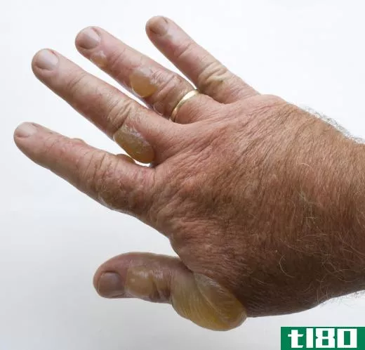 A man with poison oak blisters on his hand.