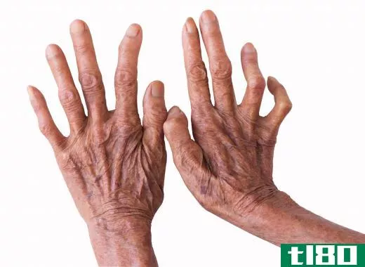 Later symptoms of leprosy include weakness of the hands.