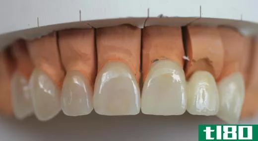 Porcelain veneers may be the best solution for badly chipped teeth.