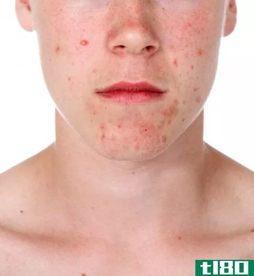 Non-comedogenic moisturizer may be used to help fight acne.