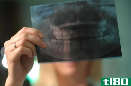 Dental x-rays are typically used to guide dentists when they repair chipped teeth.