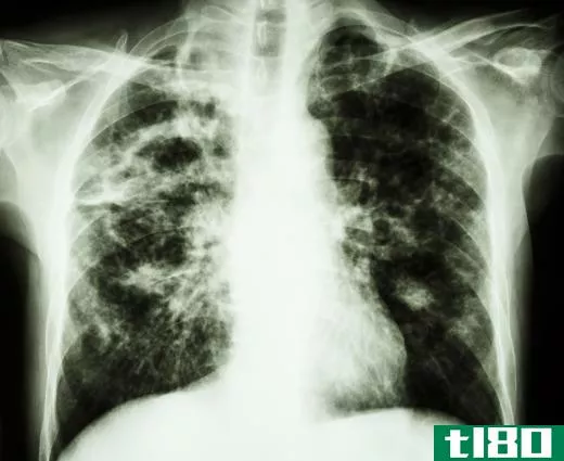 Tuberculosis is an example of a pathogenic bacterium.