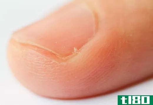 A person with a hangnail, a small tear in a cuticle.