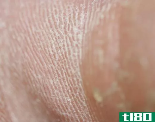 A skin callus may be defined as a patch of hard, rough skin that may develop due to friction.