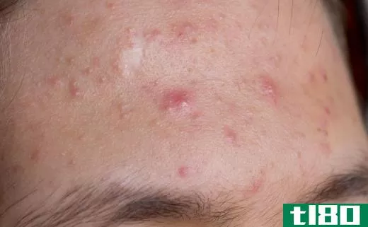 A close up of acne.