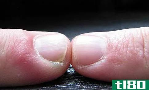 The parallel lines that run from the base to the tip of a fingernail become more prominent with age.