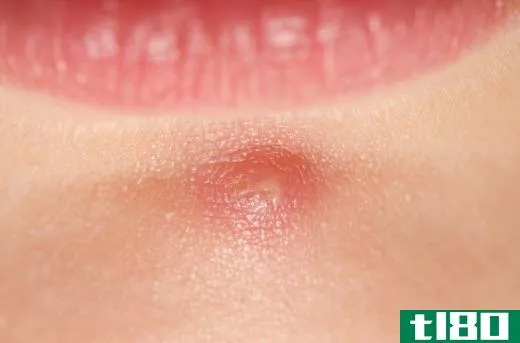 Acne vulgarism frequently appears as red bumps on the face.