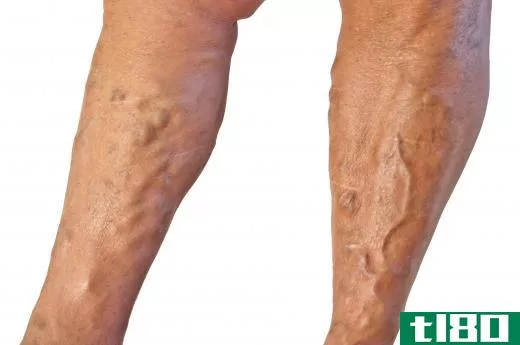 Clay sage is sometimes used in the treatment of varicose veins.