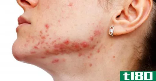 Facials may help reduce acne.
