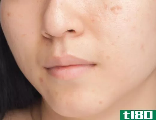 A complexion bar may be used to treat acne on the face.