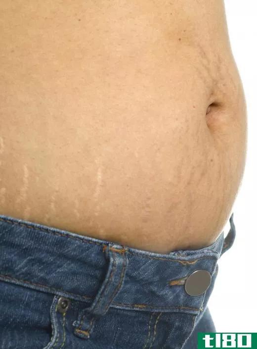 A body chemical peel may be done to remove stretch marks.