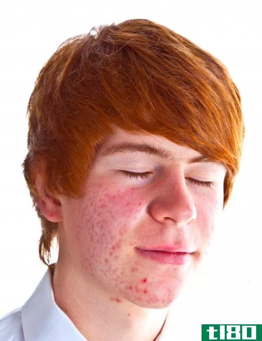 A boy with acne.