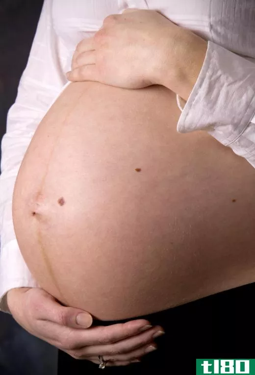 Many women develop stretch marks as the abdominal skin changes during the course of a pregnancy.