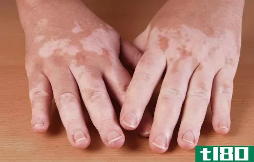Liquid and cream concealers work well on conditions like vitiligo.
