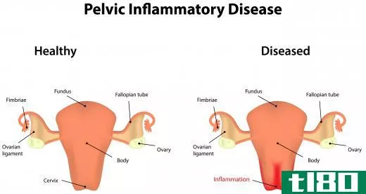 Douching may lead to serious issues like pelvic inflammatory disease.