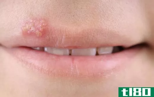 Lip conditioner may help heal cold sores.