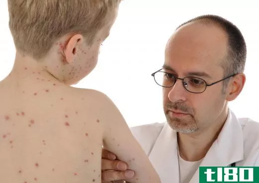 Chicken pox scars can be eliminated later in life.
