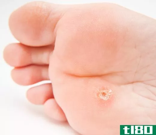 Trichloroacetic acid is sometimes used to treat warts.