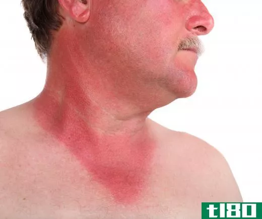 A sunburned man.