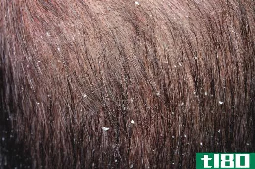 A person with dandruff may benefit from using phyto shampoo.