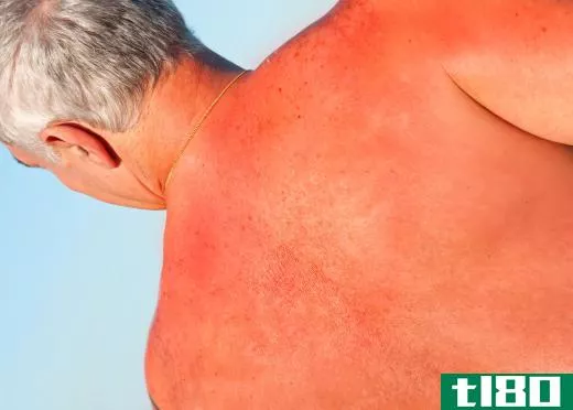 UVB rays from the sun may cause sunburn on the top layer of the skin.