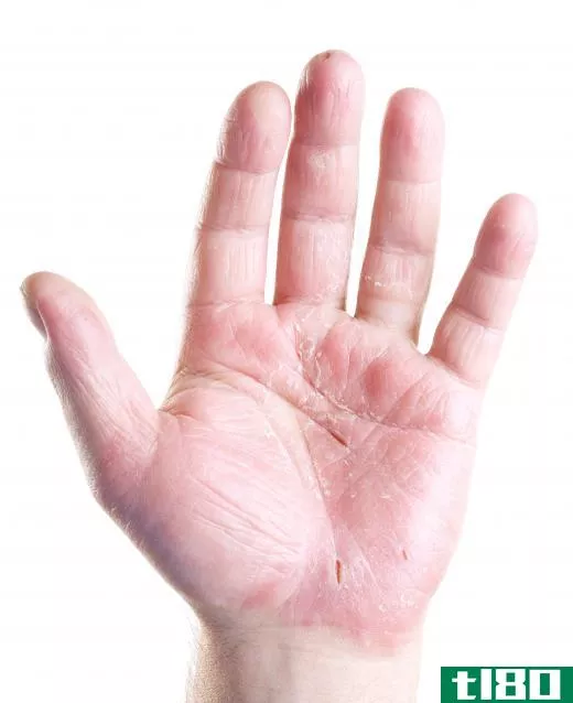 The use of some face lotions on the hands may lead to cracking of the skin.
