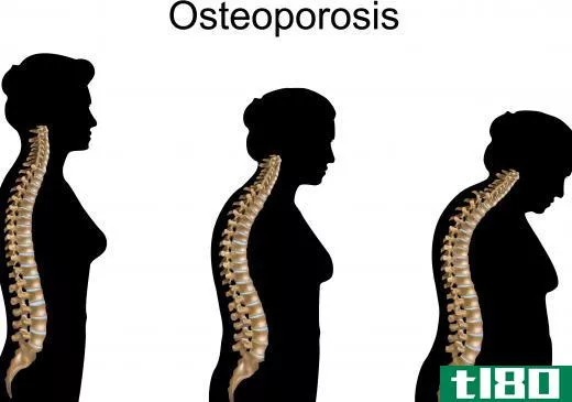 People who have osteoporosis may benefit from nettle oil.
