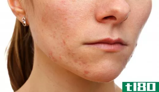 Salicylic acid is commonly used to treat acne.