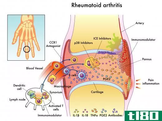 Chicken collagen may be useful for treating rheumatoid arthritis.