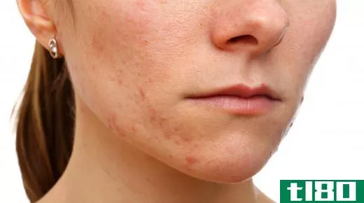 Salicylic acid is often used in acne medications.